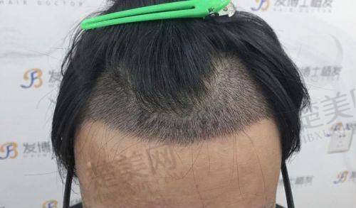 二、北京碧莲盛植发的核心技术体系