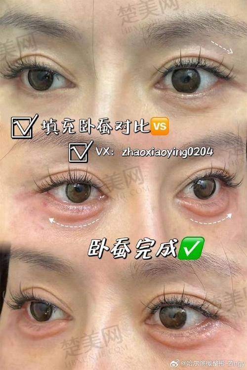五、卧蚕填充后的护理