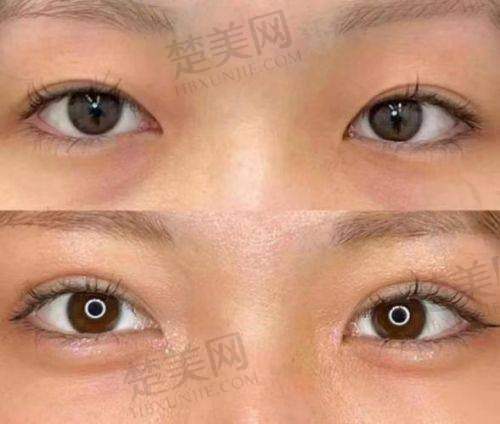 卧蚕填充多少钱一次？受材料、地区、医生等因素影响价格差异大！