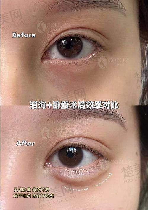 一、卧蚕填充的常见方式及价格范围
