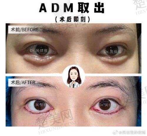 三、卧蚕填充的注意事项