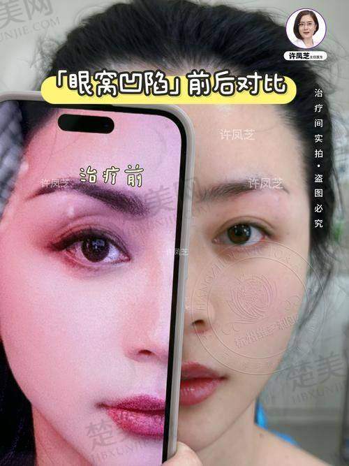 七、玻尿酸填充除皱的术后注意事项