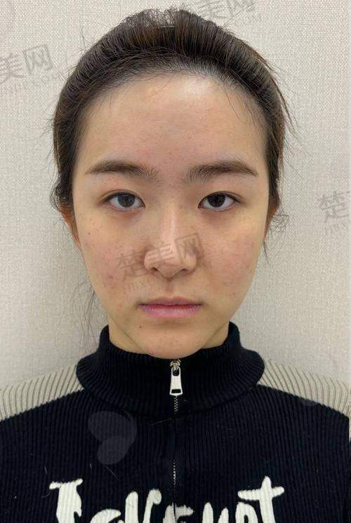 一、玻尿酸填充除皱的基本原理和特点