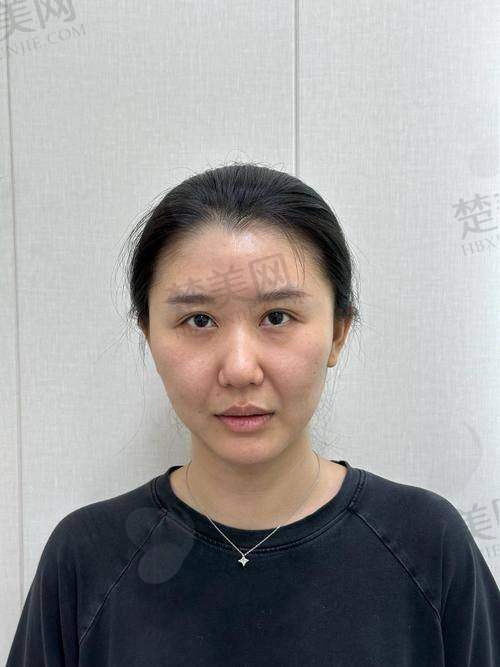 四、玻尿酸填充除皱的成效维持时间