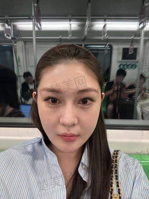 二、弗缦胶原蛋白填充卧蚕实例分享