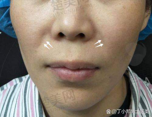 四、不同法令纹程度的方案选择及价格