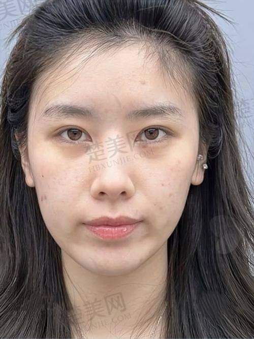 三、尿酸高是怎么回事之诊断方法