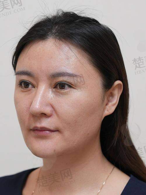 四、尿酸高是怎么回事之治疗手段