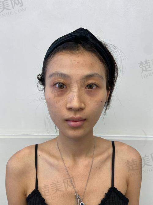 三、不同情况注射一支玻尿酸的具体价格参考