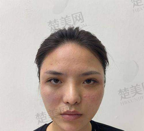 一、尿酸高是怎么回事之升高原因