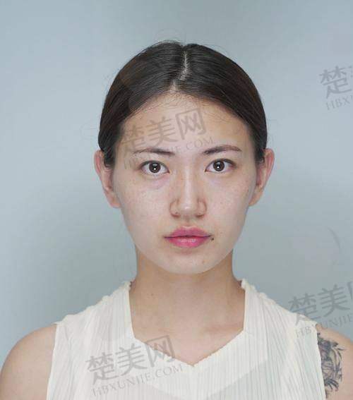 五、脸部填充大概多少钱之美学与安心提示