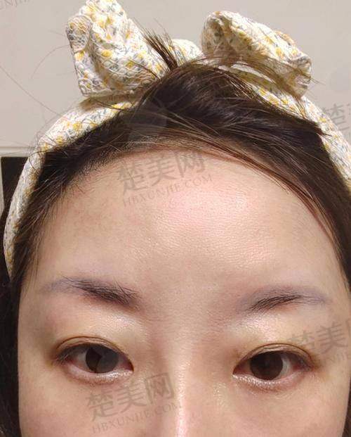 五、祛抬头纹方案组合参考