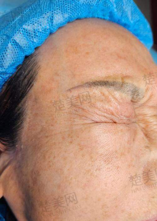一、抬头纹形成的原因