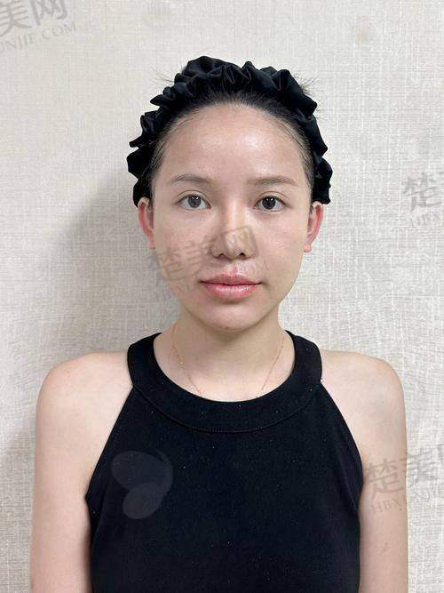 五、去除重度的抬头纹后注意事项