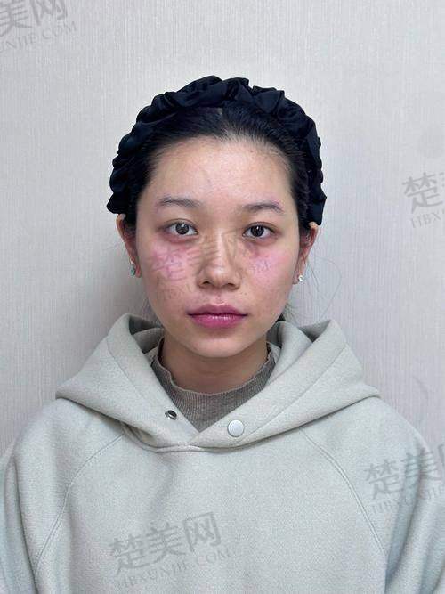 三、医美手段去除重度的抬头纹全攻略