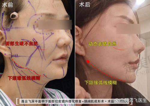 四、倪锋医生拉皮手术价格