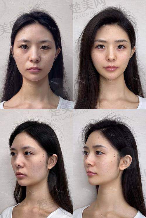 五、脸部填充需要多少钱之实例分享