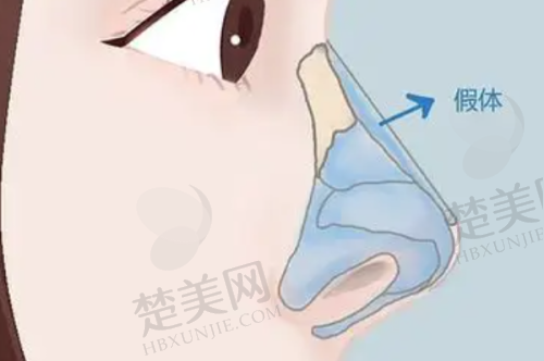 三、广州肖强医生的技术优势