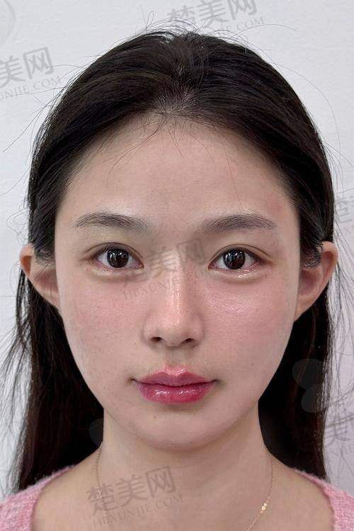 二、影响鼻子玻尿酸价格的因素