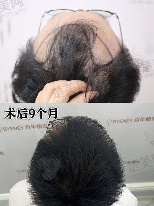 一、武汉仁爱医院植发科的正规性