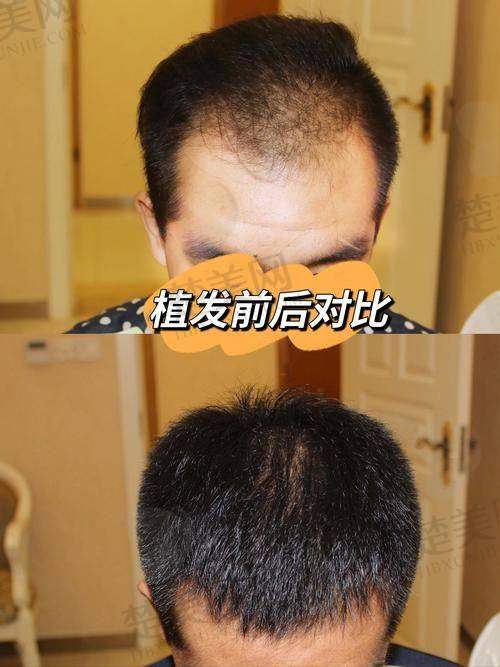 植发技术相关项目