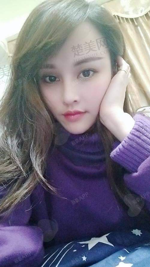 二、自体活细胞填充法令纹的成效