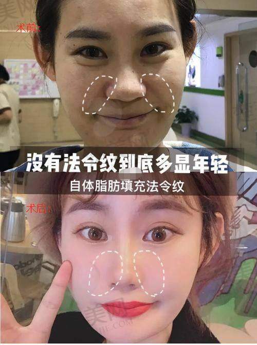 三、自体活细胞填充法令纹的优势