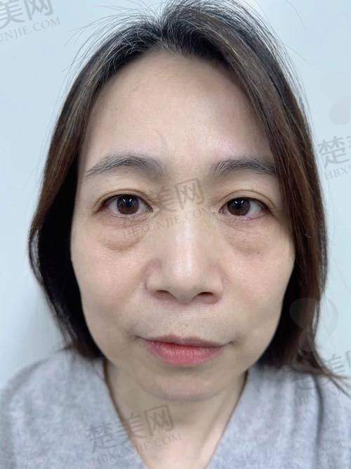 深圳祛眼袋医生排行榜揭晓！胡华新、李天石等医生技术精湛经验丰富值得信赖