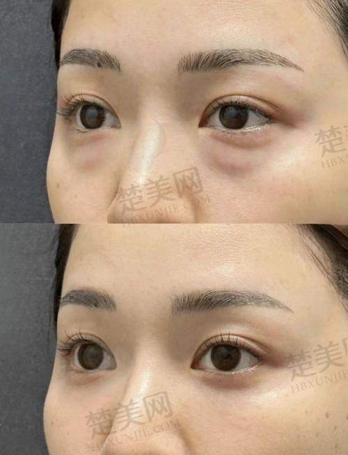 四、深圳美莱医疗美容医院——梁志为医生