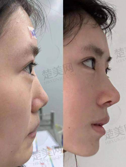 三、李信锋鼻整形技术与审美优势