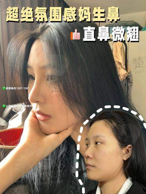五、李信锋院长的高难度鼻修复实例