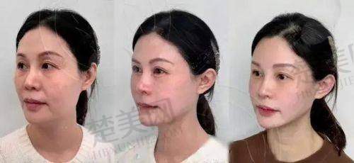 五、法令纹填充的联合抗衰手段