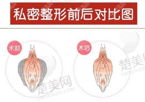 成都私密整形哪家医院好？盘点四川大学华西等多家优质公立三甲医院私密整形优势