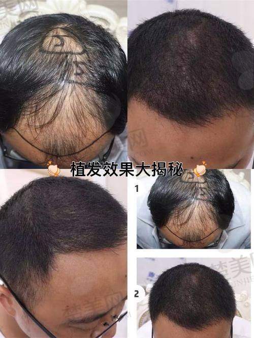 七、天津医 科 大学总医院整形美容外科：国有具有影响力的植发保护