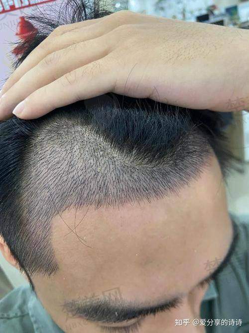 十、天津中 医 药大学第一附属医院：国有植发的不错之选