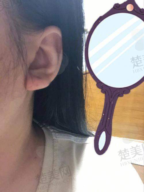 二、于晓波耳朵矫正及修复技术优势