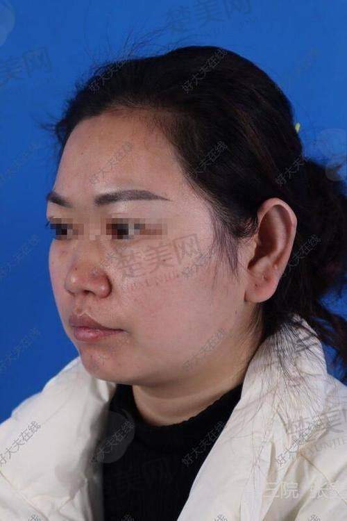 于晓波耳朵修复怎么样？技术好成效显著，个性化方案让修复耳朵真实自然！