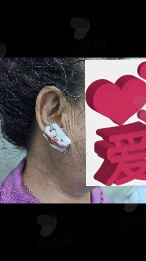 三、于晓波耳朵矫正及修复经典实例展示