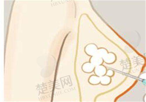 七、六安市人民医院整形科：整形项目价格参考