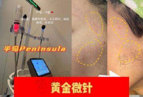 四、打熊猫针的四大坑千万别踩
