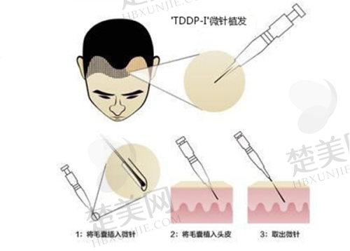 一、绵阳植发国有医院推荐