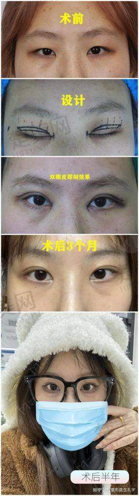 二、张嘉林医生双眼皮手术技术