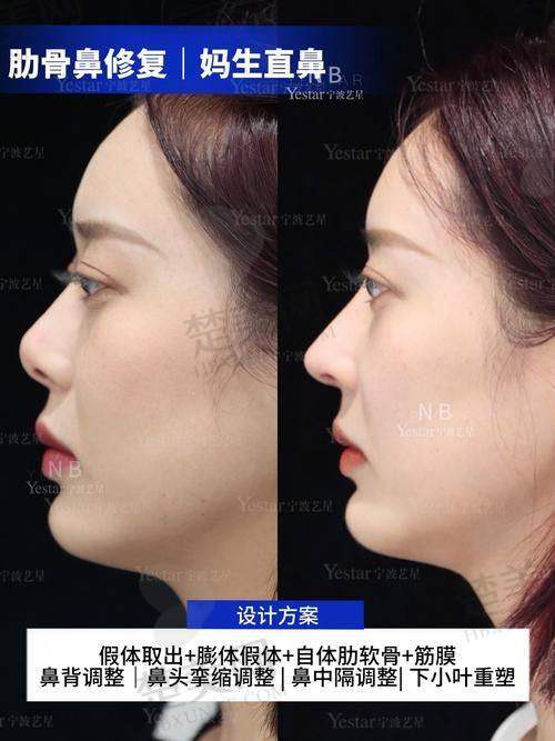 三、骆显红医生隆鼻操作细节