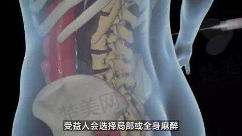 三、宋新医生隆胸技术优势