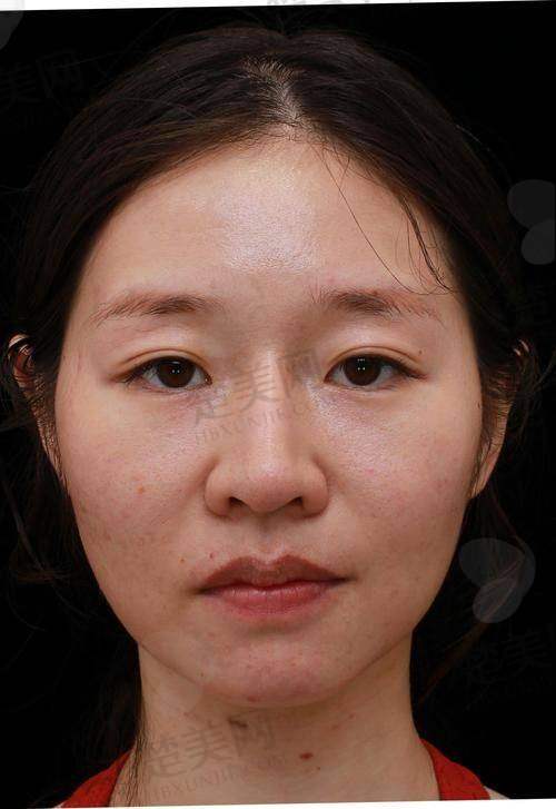 玻尿酸注射多少一针？再次提醒大家要综合考虑