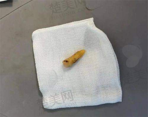 二、周云超医生异物取出的技术优势