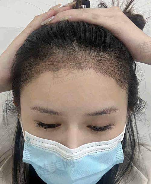 四、植发注意事项