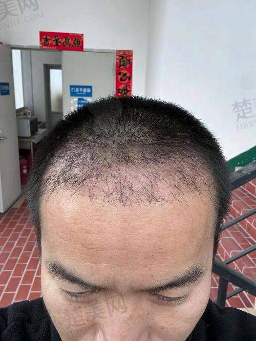 三、如何选择适合自己的植发医院