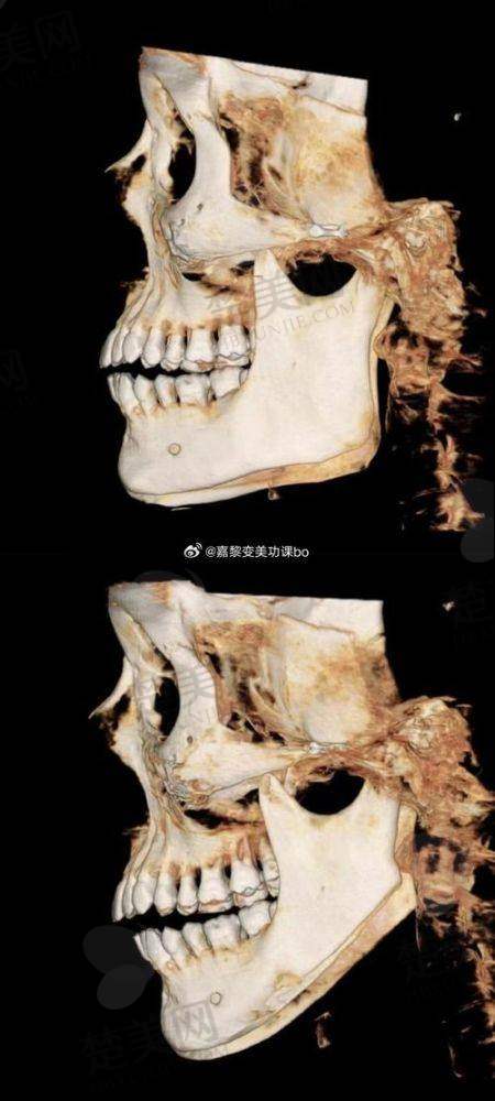 六、何晋龙医生磨骨手术价格是否值得