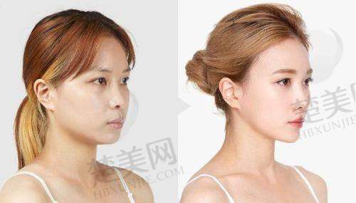 二、隆鼻手术：美丽与自信的“敲门砖”